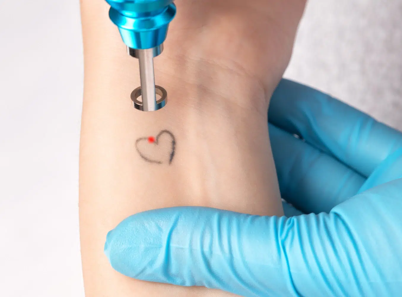 Détatouage Laser à Nancy